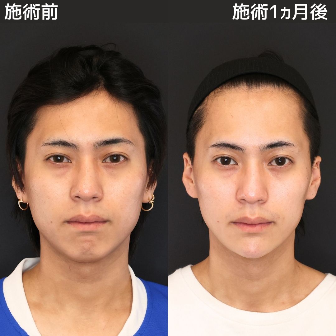 《小顔整形》エラ張り顔を解消しさらにイケメンに！