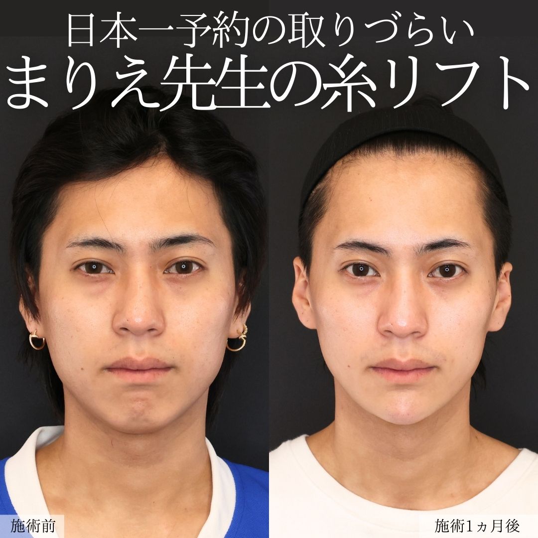 エラボトックス注射/TAC式 ツヤ肌コラーゲンリフト®/顎のヒアルロン酸注射の症例写真 施術前後 