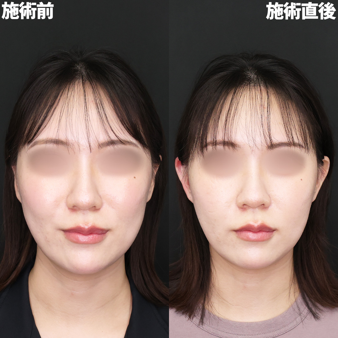 憧れのワンホン顔に！立ち耳ヒアル