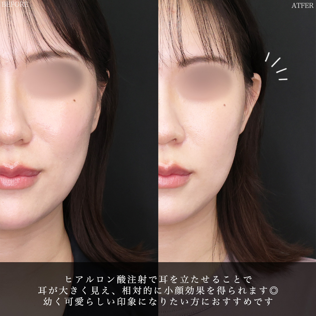 ヒアルロン酸注射：その他の症例写真 施術前後 