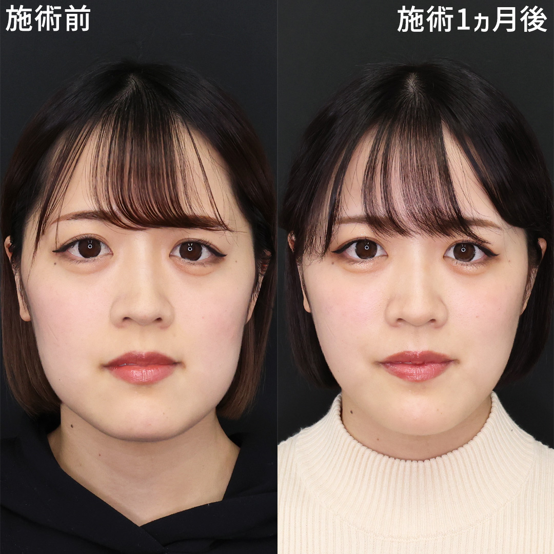 【 エラ張り改善！】糸リフトでシャープな輪郭へ