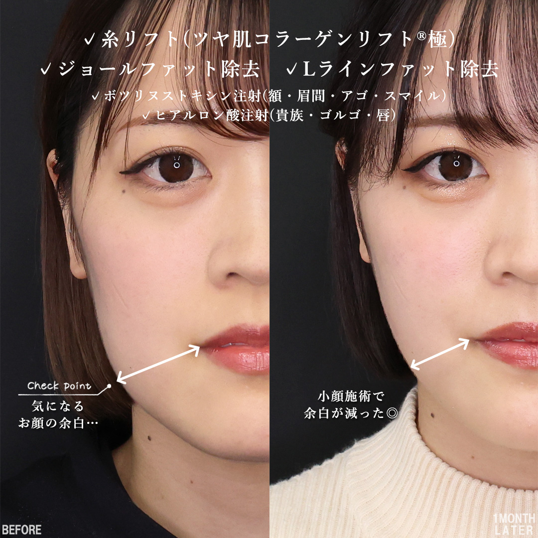 TAC式 ツヤ肌コラーゲンリフト®/Lラインファット除去（エラ下脂肪除去）/ジョールファット除去の症例写真 施術前後 