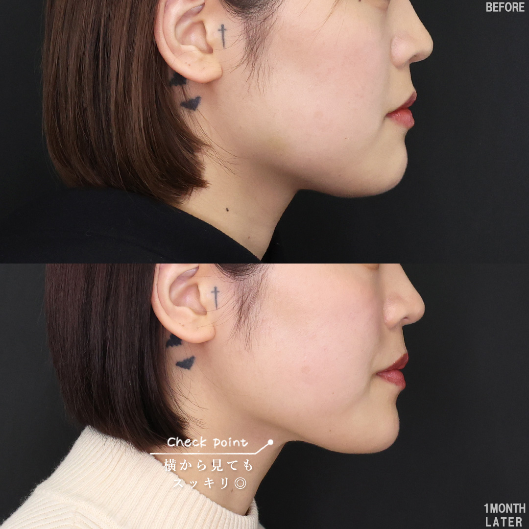 TAC式 ツヤ肌コラーゲンリフト®/Lラインファット除去（エラ下脂肪除去）/ジョールファット除去の症例写真 施術前後 