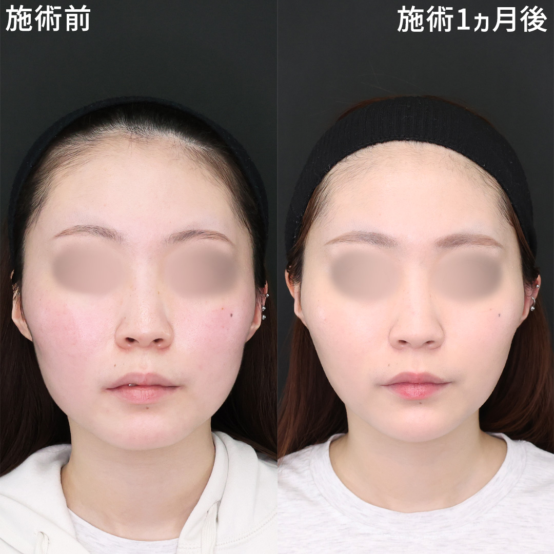 TAC式 ツヤ肌コラーゲンリフト®/エラボトックス注射/ボトックス注射:その他の症例写真 施術前後