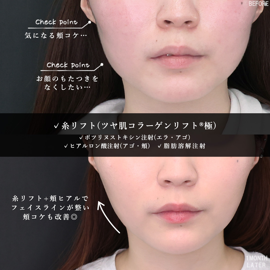 TAC式 ツヤ肌コラーゲンリフト®/エラボトックス注射/ボトックス注射:その他の症例写真 施術前後