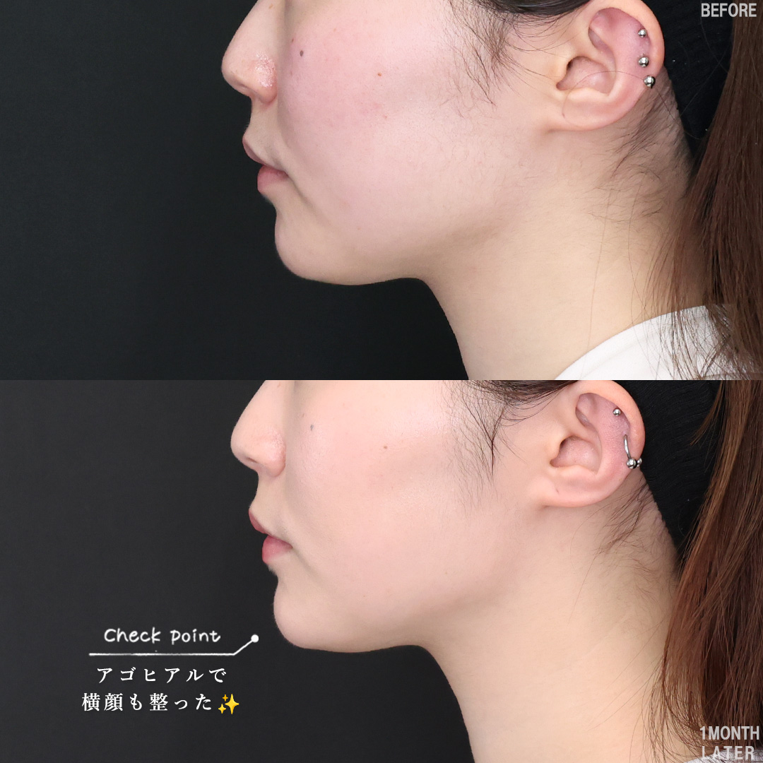 TAC式 ツヤ肌コラーゲンリフト®/エラボトックス注射/ボトックス注射:その他の症例写真 施術前後
