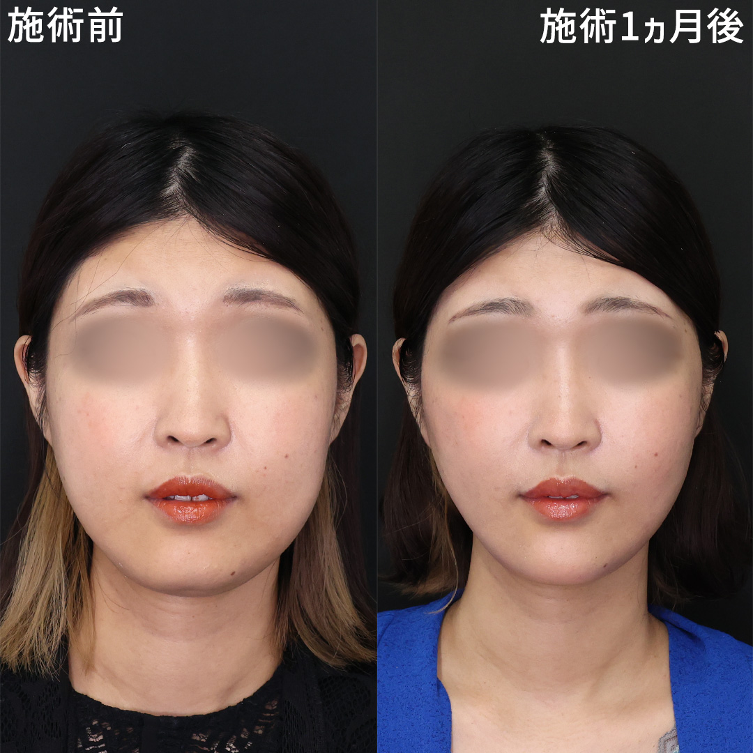 【究極の小顔術】糸リフトで顔の余白撃退！