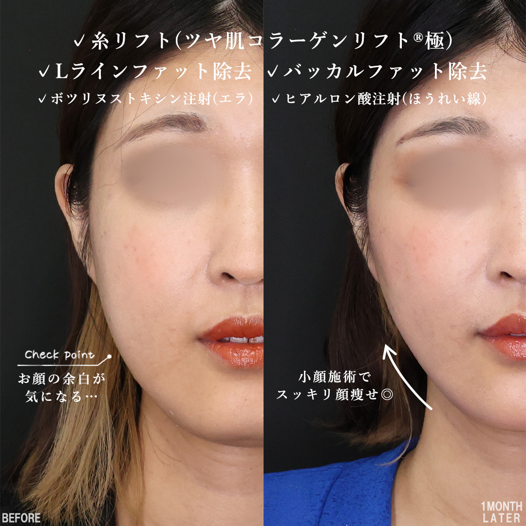 TAC式 ツヤ肌コラーゲンリフト®/バッカルファット除去/Lラインファット除去（エラ下脂肪除去）の症例写真 施術前後 