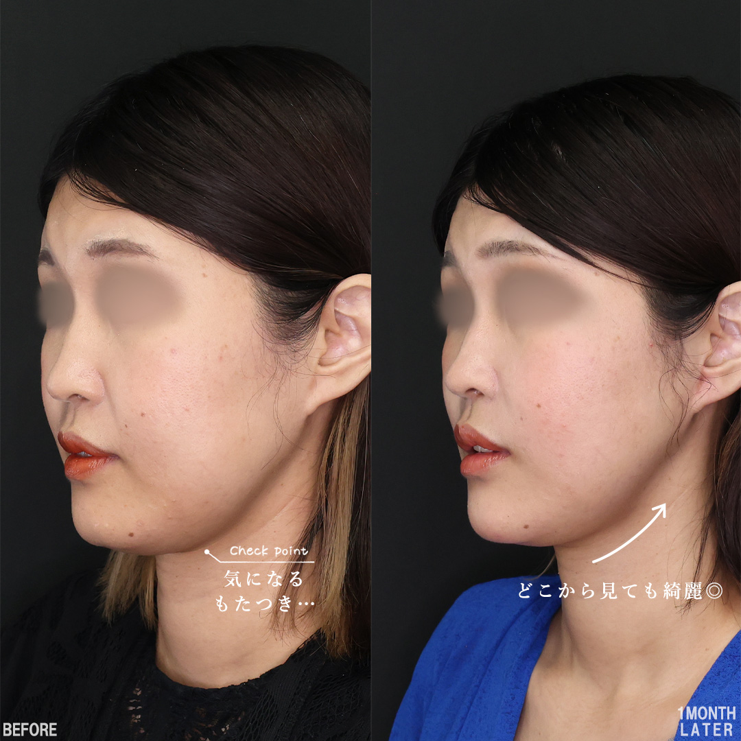 TAC式 ツヤ肌コラーゲンリフト®/バッカルファット除去/Lラインファット除去（エラ下脂肪除去）の症例写真 施術前後 