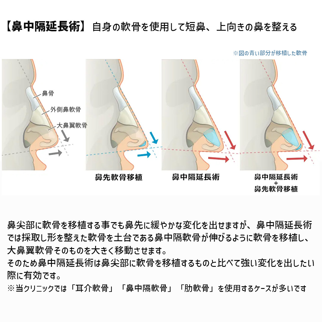 隆鼻術(プロテーゼ・自家組織)/鼻中隔延長術/鼻尖形成・鼻尖縮小の症例写真 施術前後
