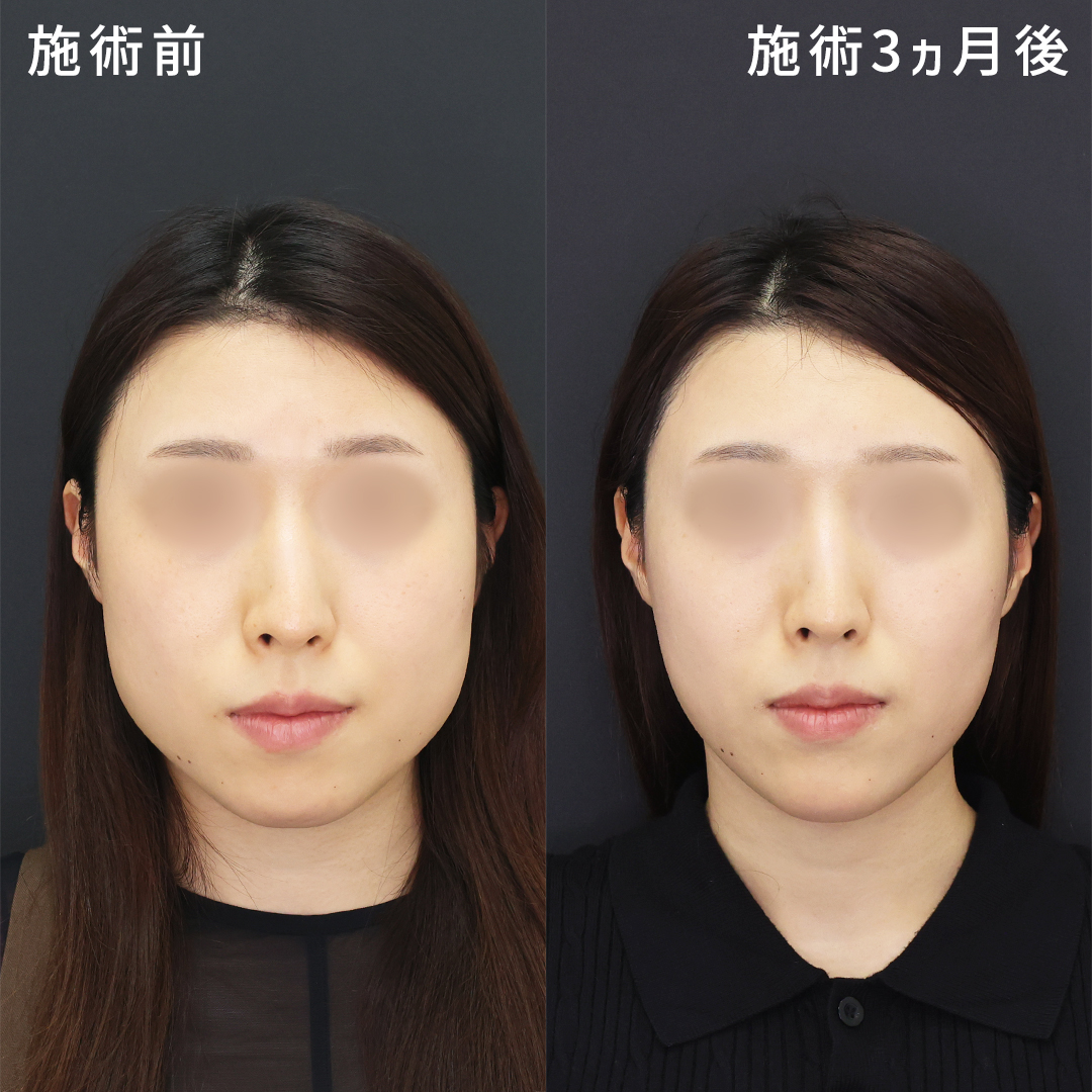 【下膨れ感改善】エラ・頬まわりのもたつきを無くし、別人級のフェイスラインに