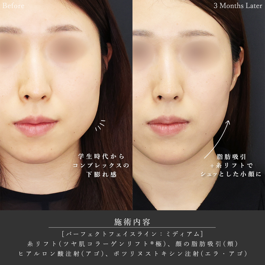 小顔整形｜パーフェクトフェイスライン/TAC式 ツヤ肌コラーゲンリフト®/顎下の脂肪吸引の症例写真 施術前後 