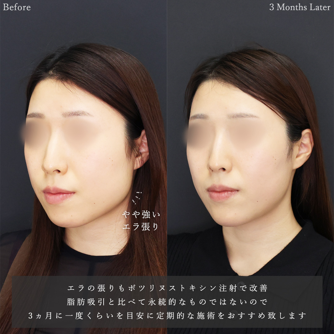 小顔整形｜パーフェクトフェイスライン/TAC式 ツヤ肌コラーゲンリフト®/顎下の脂肪吸引の症例写真 施術前後 