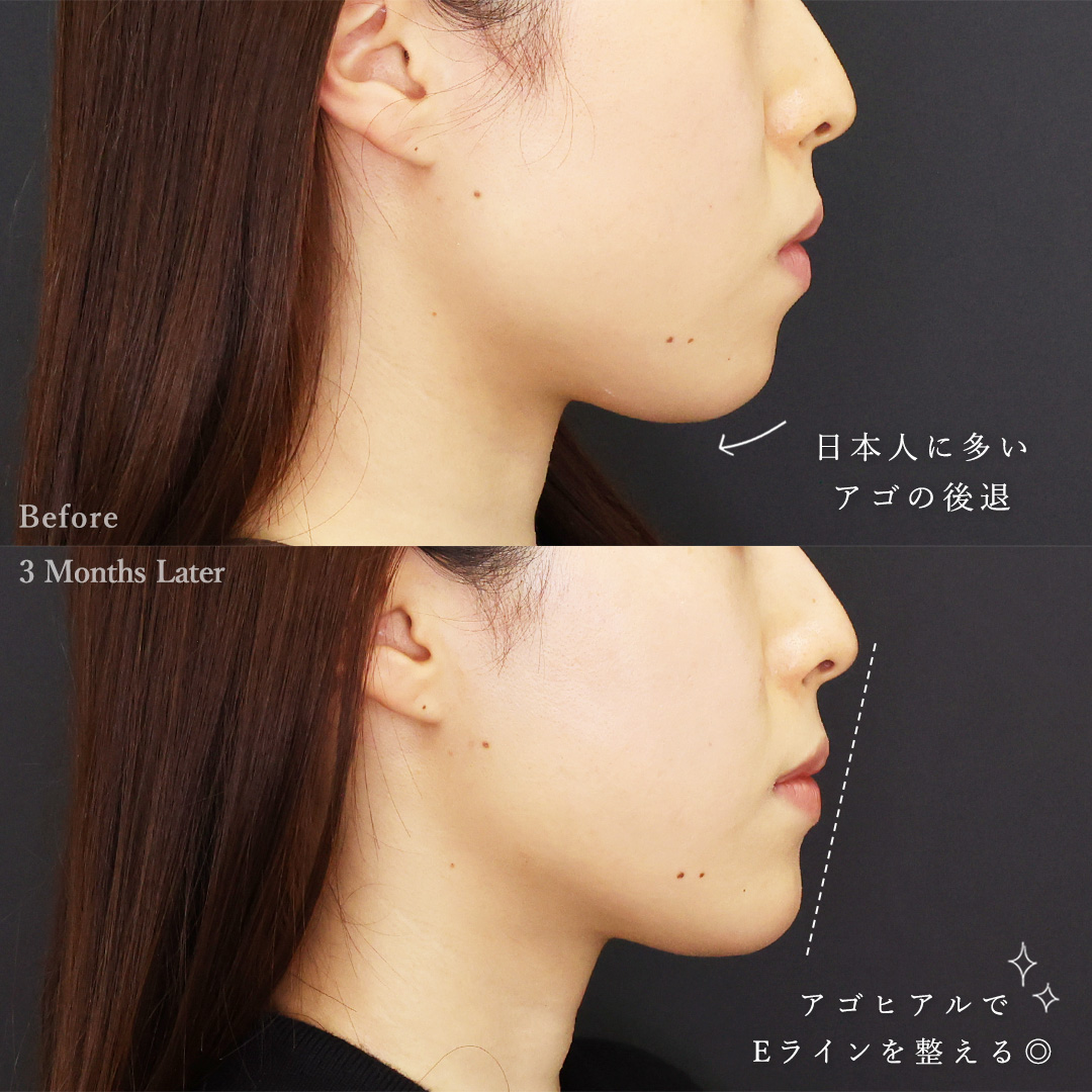 小顔整形｜パーフェクトフェイスライン/TAC式 ツヤ肌コラーゲンリフト®/顎下の脂肪吸引の症例写真 施術前後 