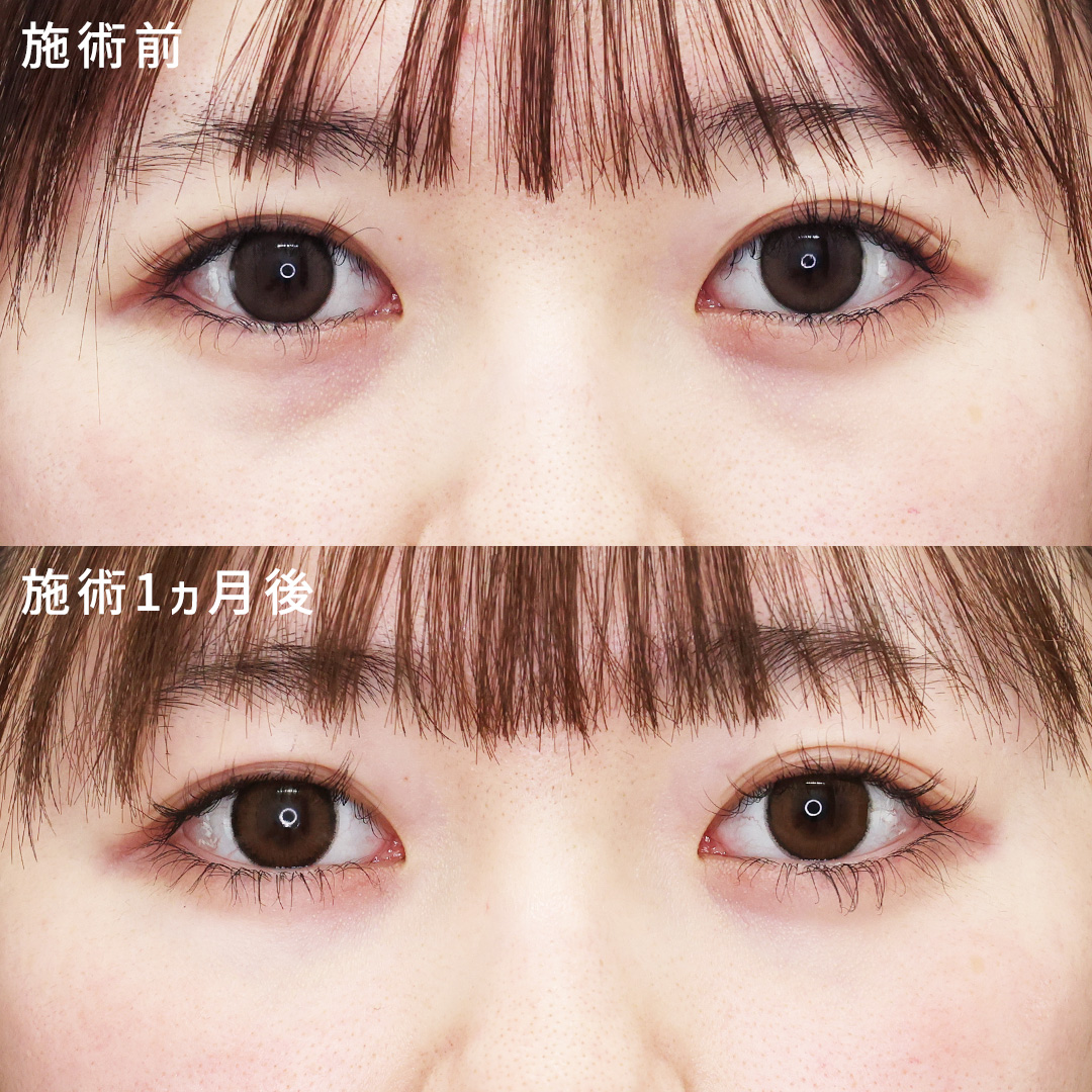 【20代女性】目の下のクマ取りでより可愛く明るい印象に◎