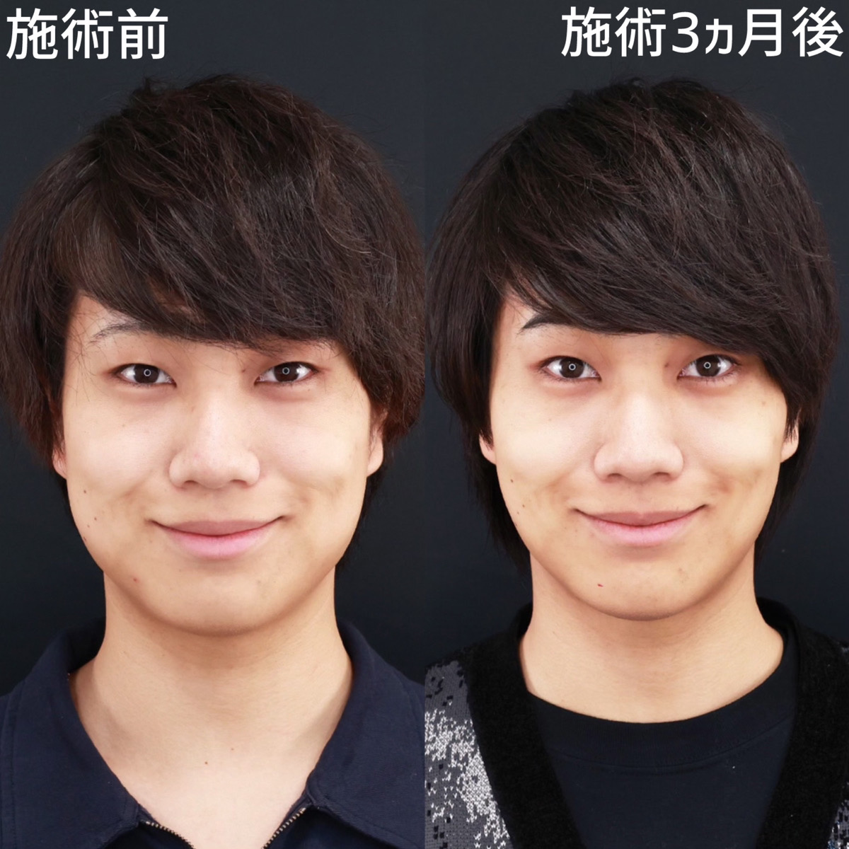 【糸リフト極×バッカルファット除去】お顔の余白を減らしスッキリ小顔に！