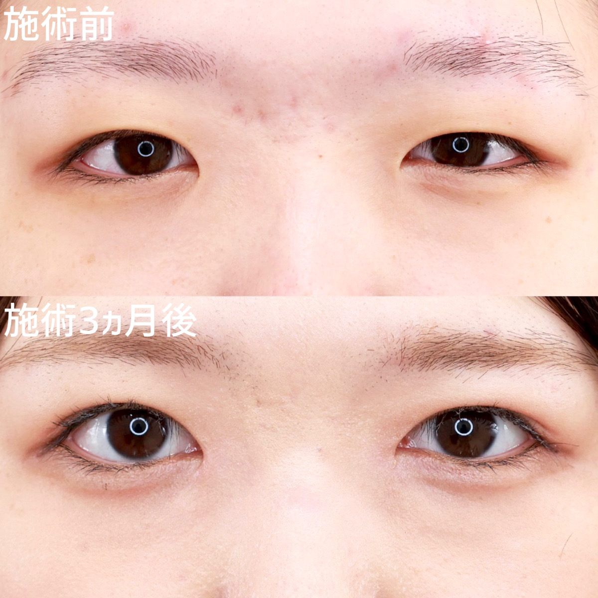 【二重埋没法×目頭切開術】目元の印象をガラッと変えて、華やかな印象に!
