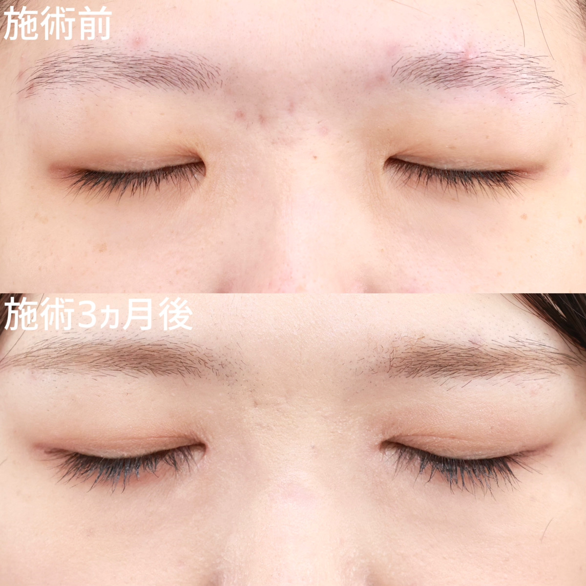クイックコスメリング/目頭切開術の症例写真 施術前後 