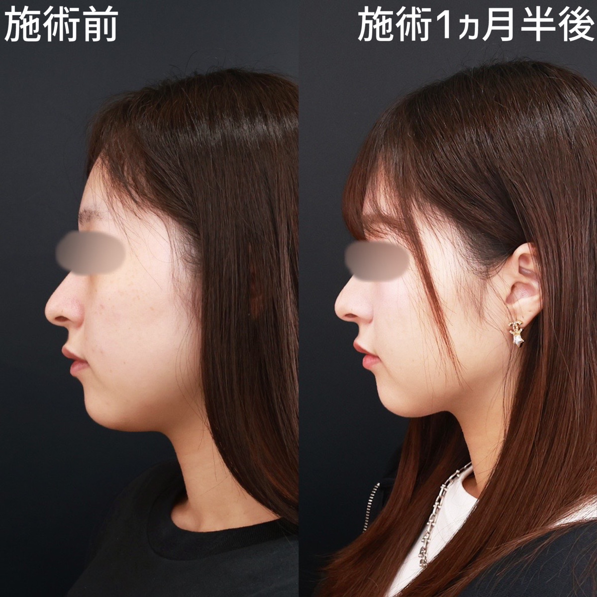 【顎下脂肪吸引】顎下をスッキリさせて、もたつきの無いフェイスラインへ！