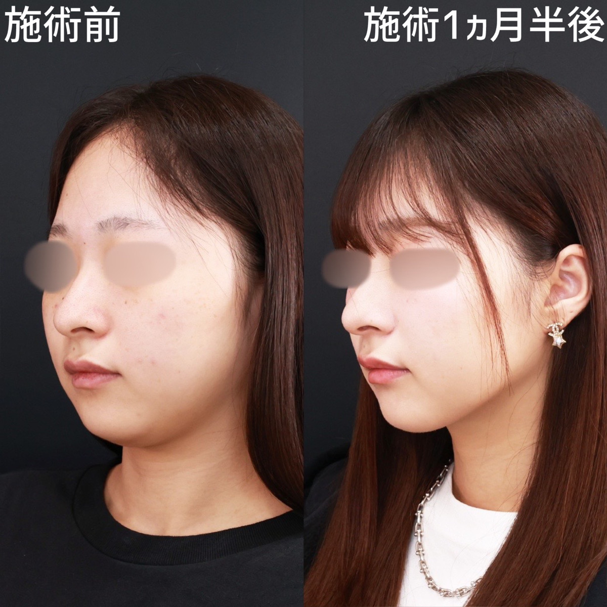 顎下の脂肪吸引/ジョールファット除去/エラボトックス注射の症例写真 施術前後 