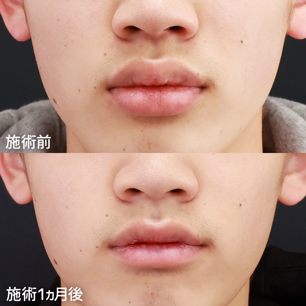 【男性の口唇縮小術】厚みを減らして、悪目立ちしない唇に