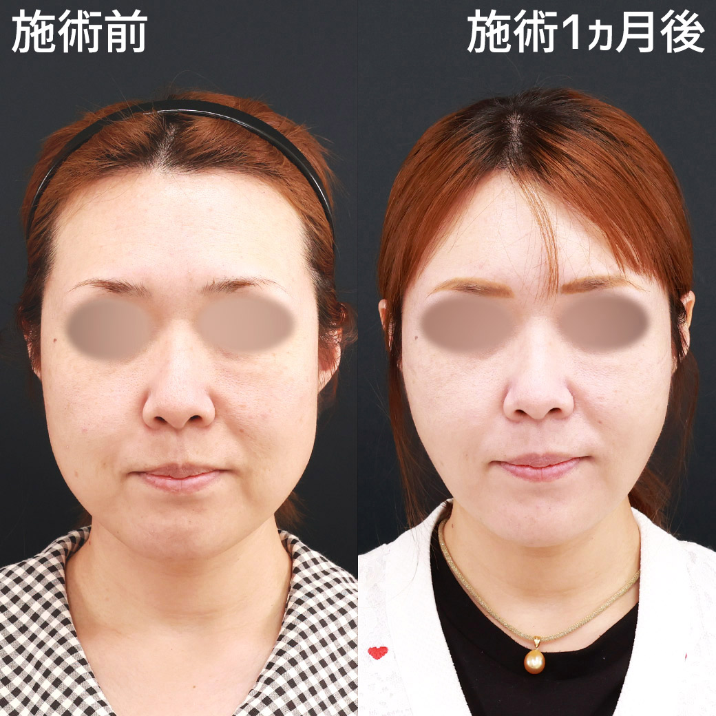 【糸リフト＆脂肪吸引】ナチュラルな若返りを叶える小顔整形
