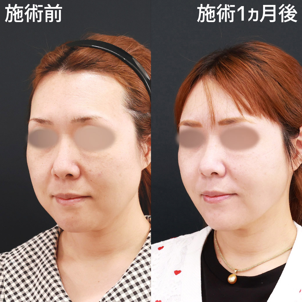 TAC式 ツヤ肌コラーゲンリフト®/ジョールファット除去/バッカルファット除去の症例写真 施術前後 