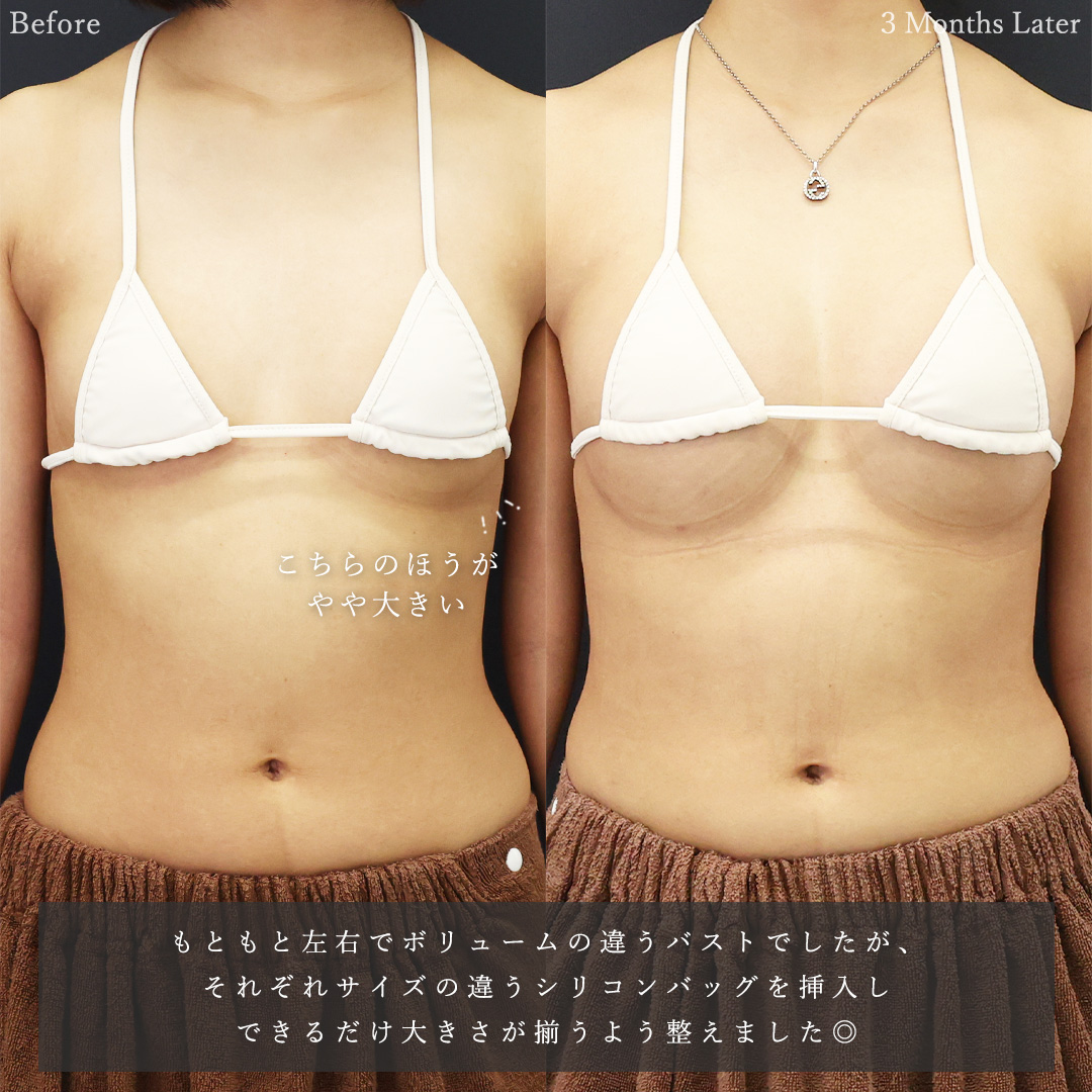 シリコンバッグ豊胸(人工乳腺バッグ)の症例写真 施術前後