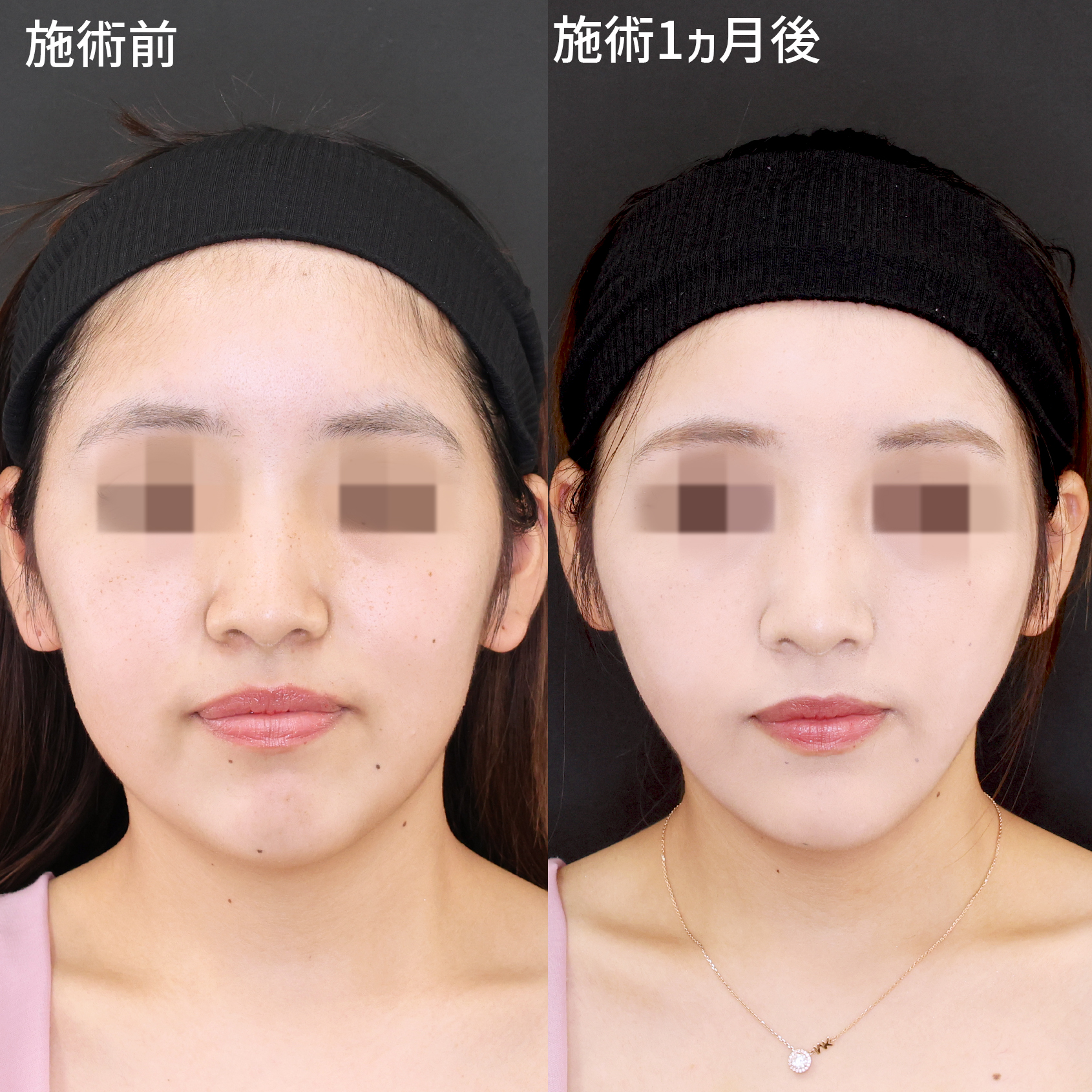 TAC式 ツヤ肌コラーゲンリフト®/顔の脂肪吸引/Lラインファット除去(エラ下脂肪除去)の症例写真 施術前後