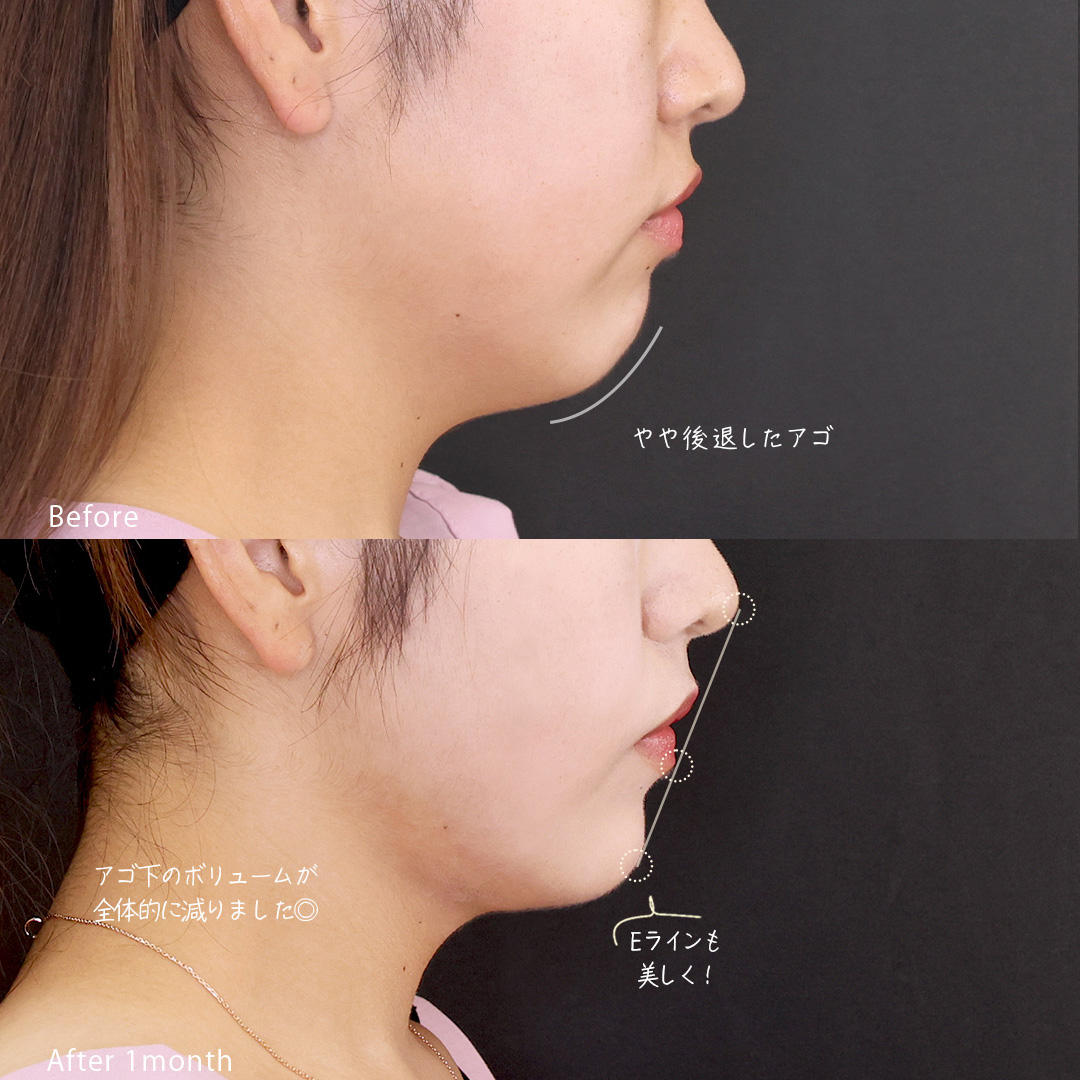 TAC式 ツヤ肌コラーゲンリフト®/顔の脂肪吸引/Lラインファット除去(エラ下脂肪除去)の症例写真 施術前後