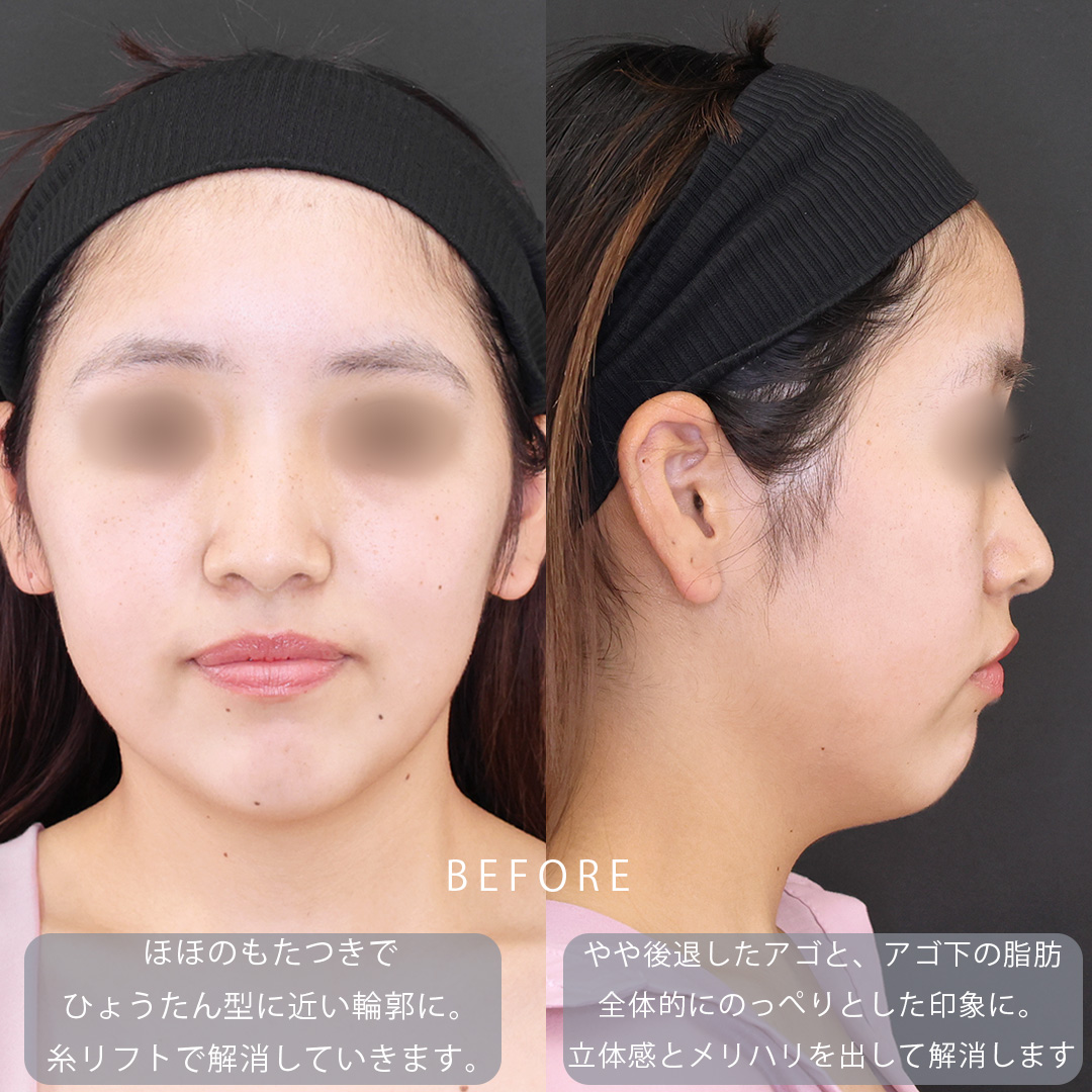 TAC式 ツヤ肌コラーゲンリフト®/顔の脂肪吸引/Lラインファット除去(エラ下脂肪除去)の症例写真 施術前後