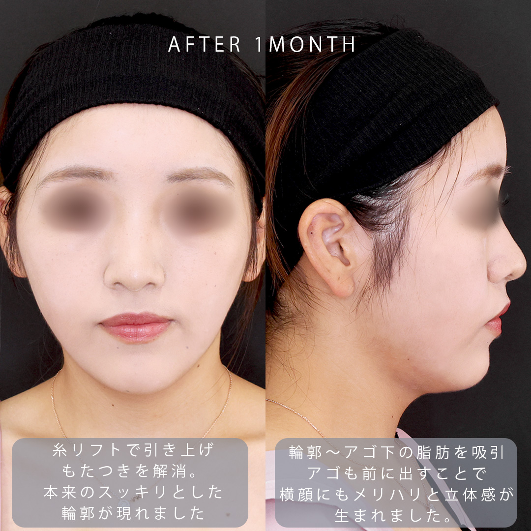 TAC式 ツヤ肌コラーゲンリフト®/顔の脂肪吸引/Lラインファット除去(エラ下脂肪除去)の症例写真 施術前後