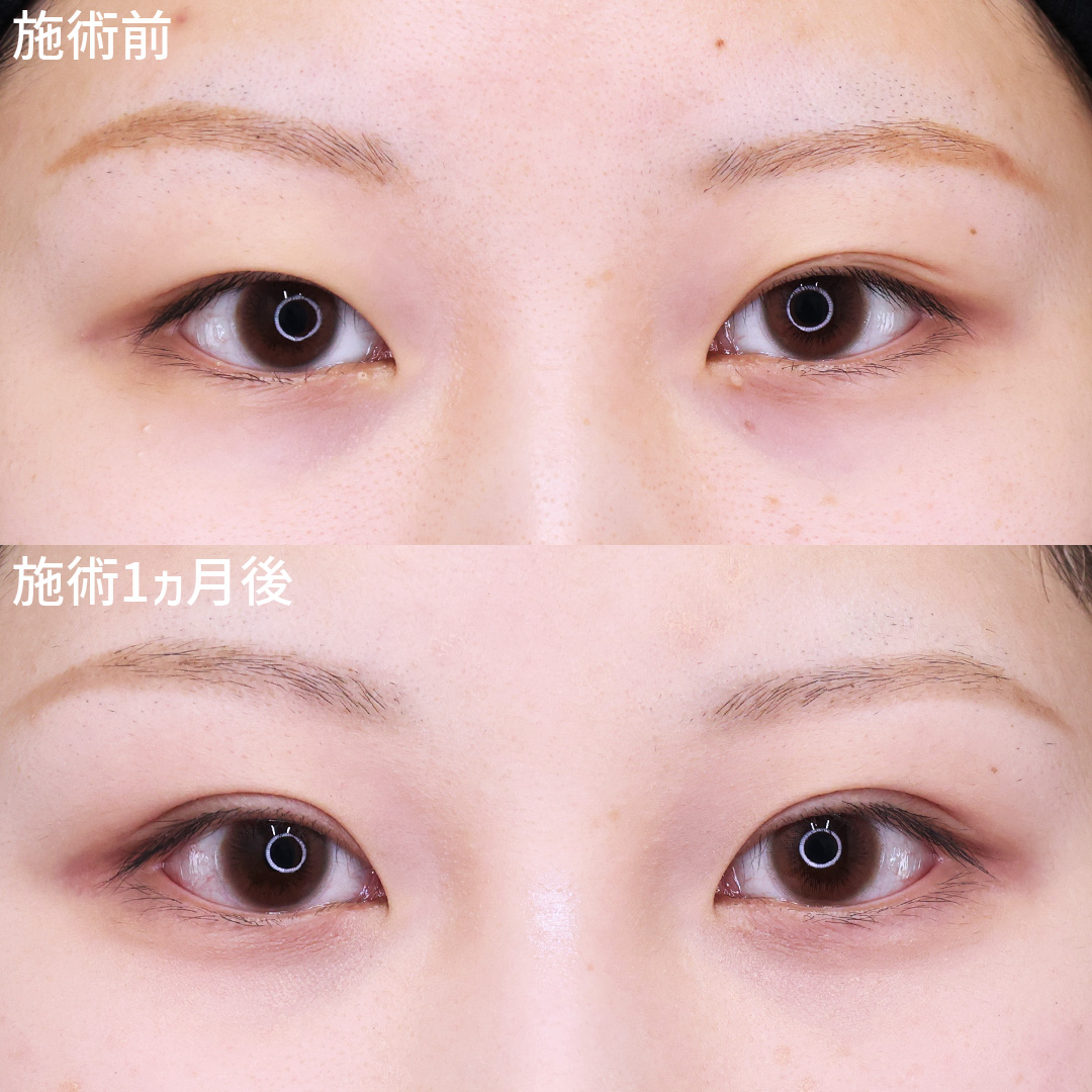 左右の目のお悩みを【埋没法】で改善◎ぱっちりくっきり、より綺麗なお目元に！