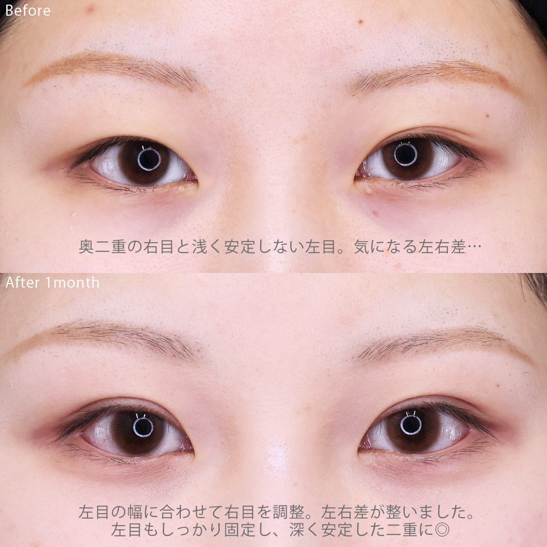 二重埋没法の症例写真 施術前後 