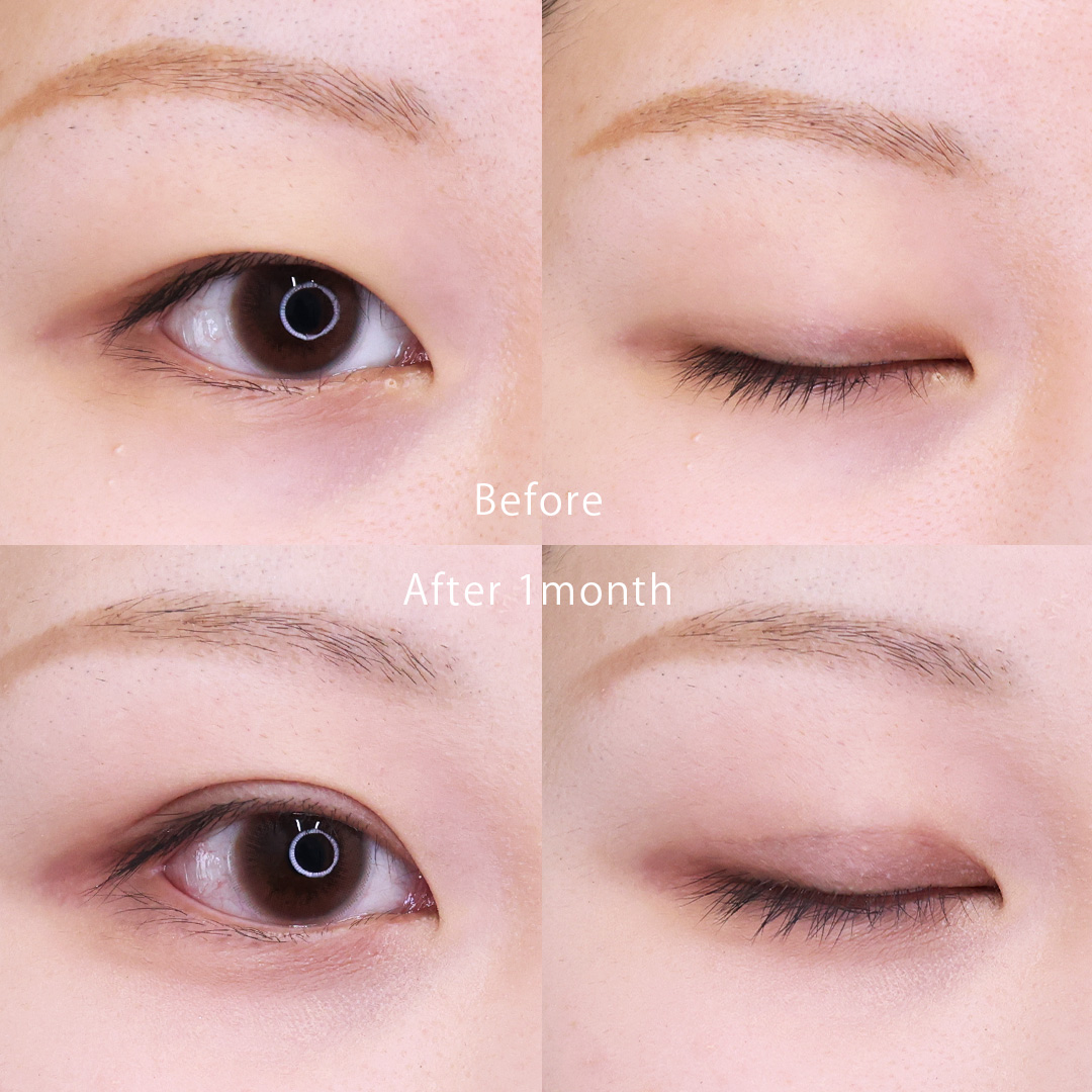 二重埋没法の症例写真 施術前後 