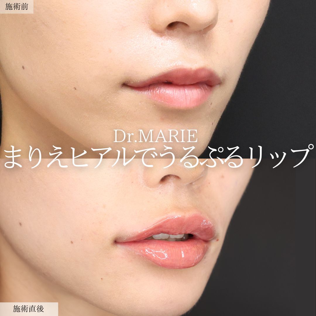 M字リップ形成術の症例写真 施術前後 