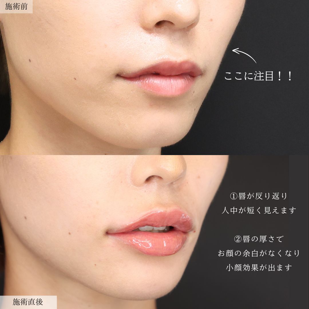 M字リップ形成術の症例写真 施術前後 