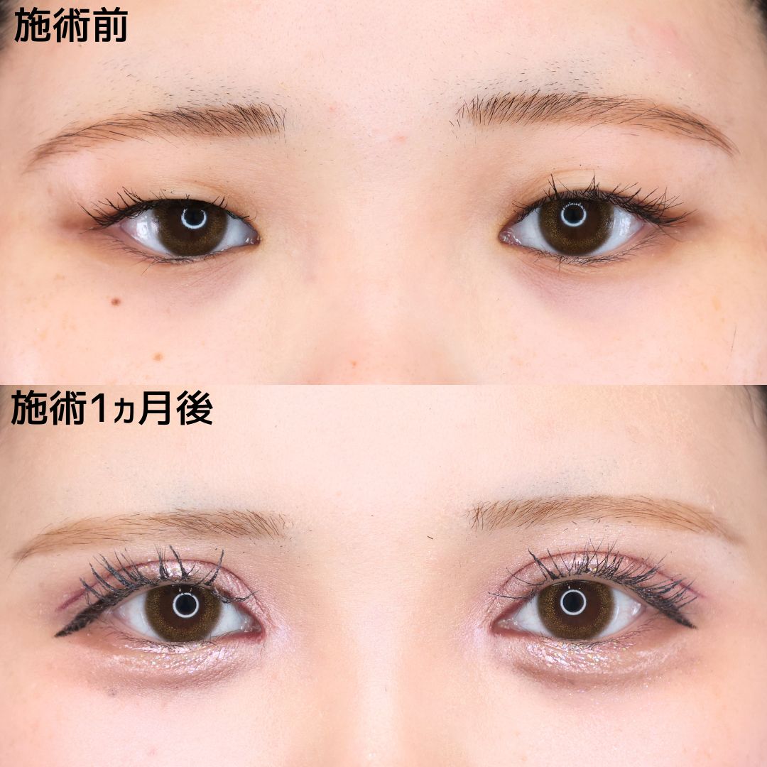 《目元切開術》アイドル風の可愛い目元になれました♡