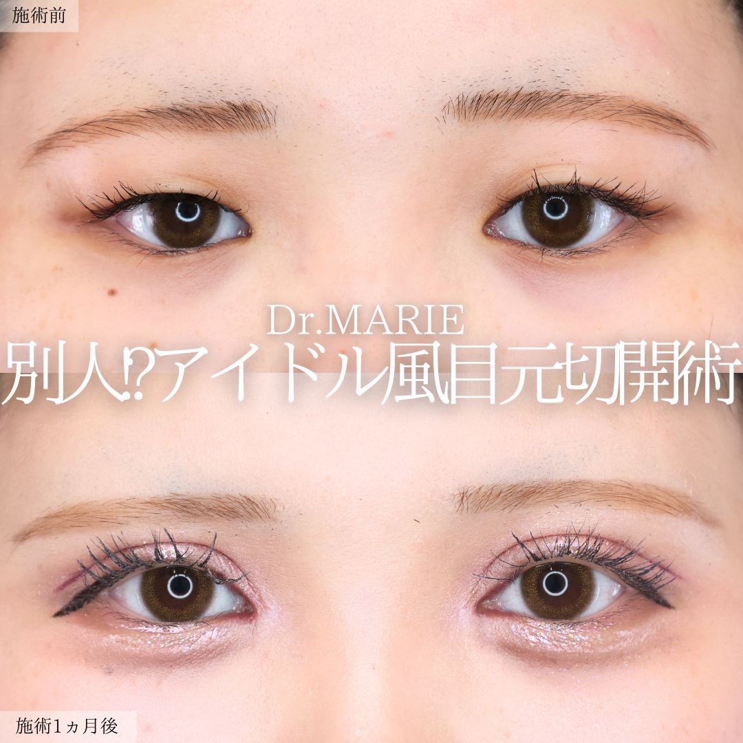 上眼瞼切開術/目頭切開術の症例写真 施術前後 