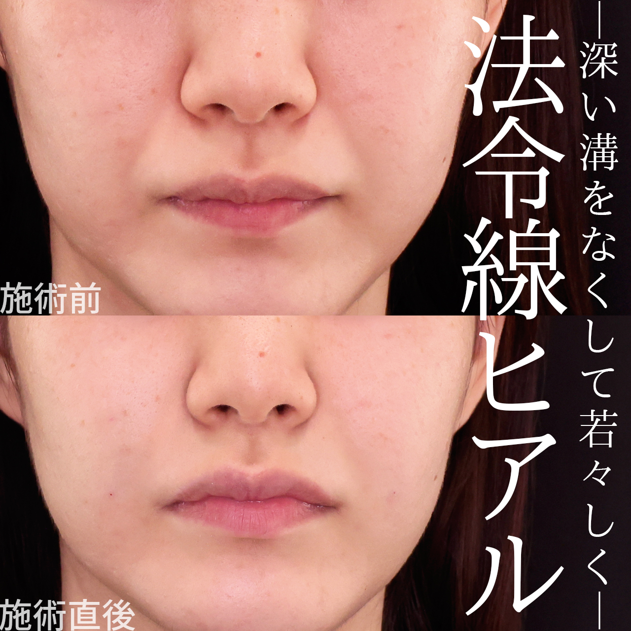 ほうれい線のヒアルロン酸注射の症例写真 施術前後 