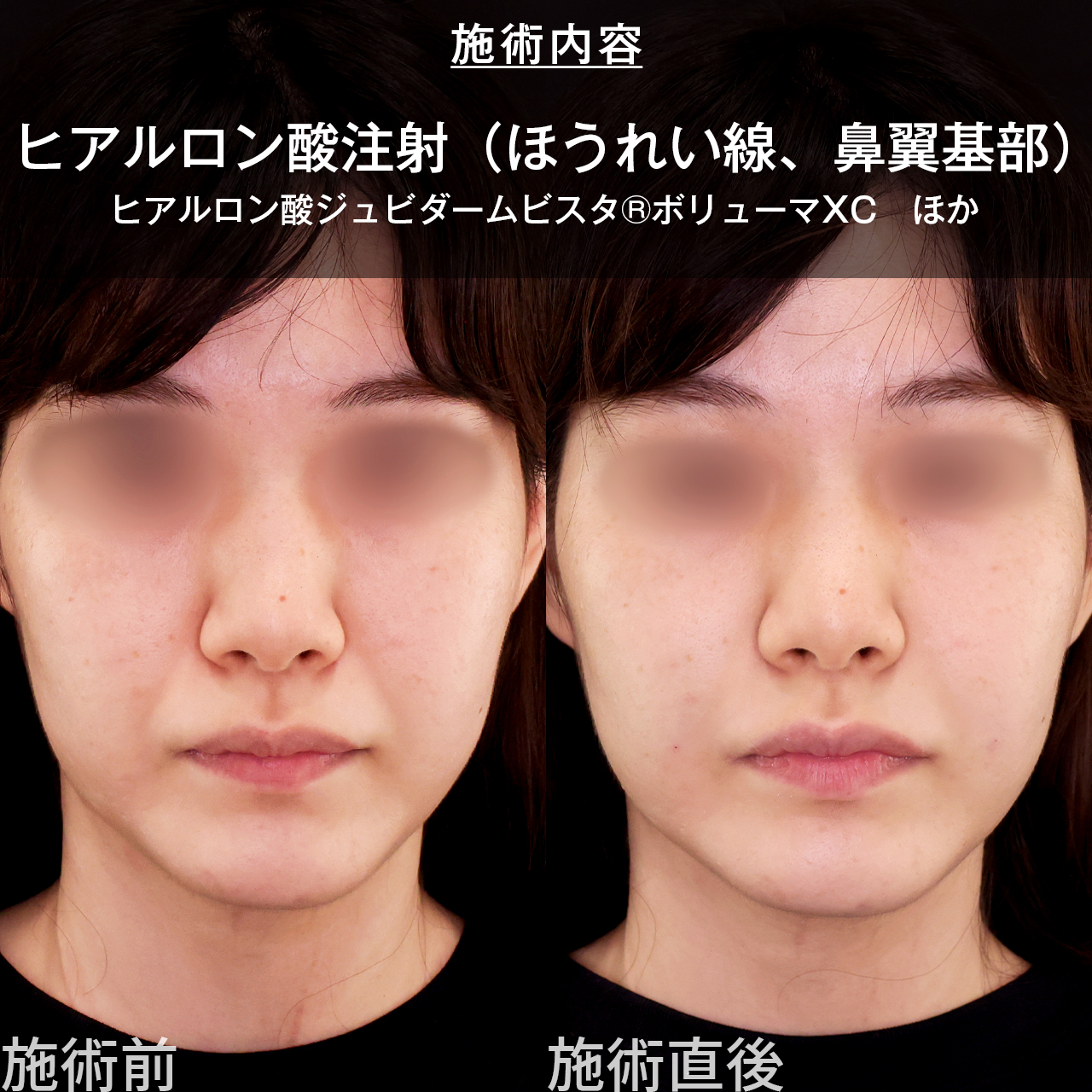 ほうれい線のヒアルロン酸注射の症例写真 施術前後 