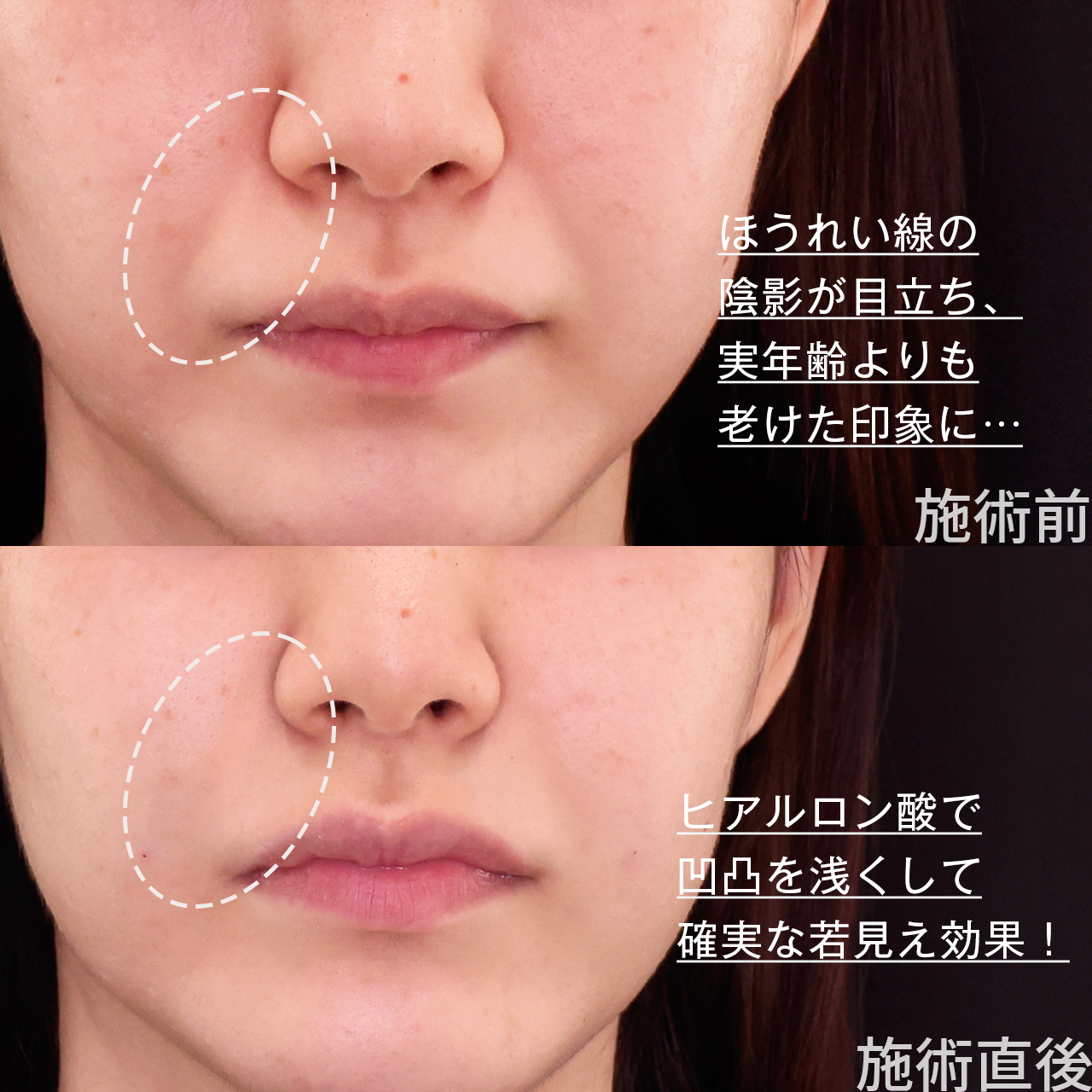ほうれい線のヒアルロン酸注射の症例写真 施術前後 