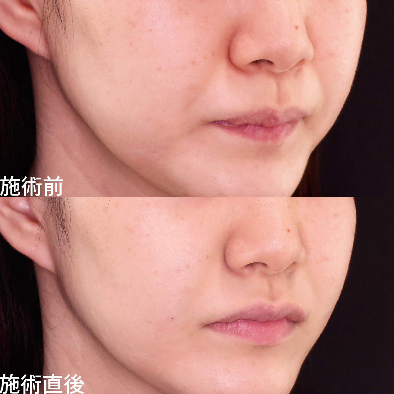 ほうれい線のヒアルロン酸注射の症例写真 施術前後 