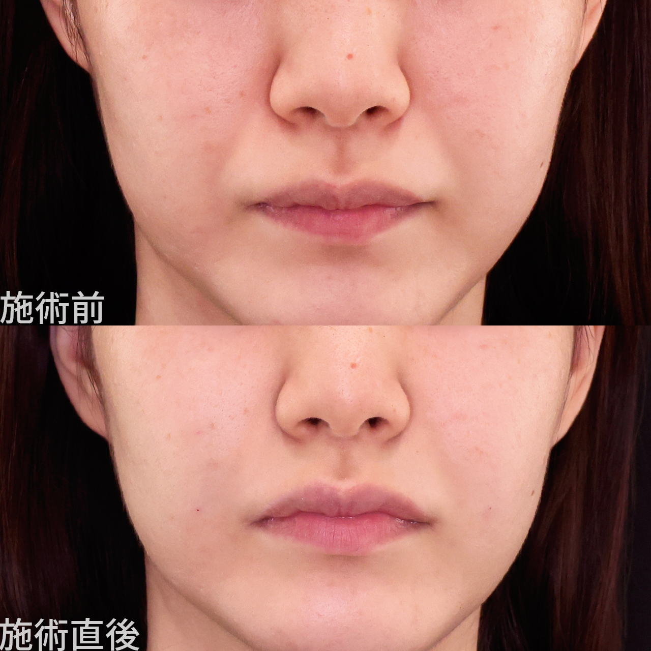 即日効果実感！Dr.森のほうれい線ヒアル