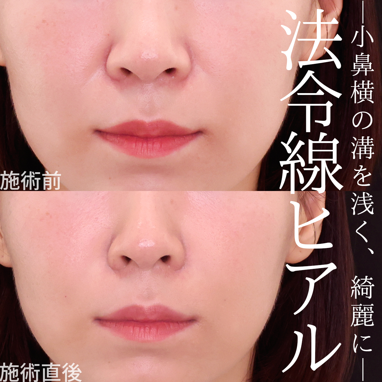 ほうれい線のヒアルロン酸注射/貴族手術（鼻翼基部プロテーゼ・脂肪注入・粉砕肋軟骨移植）の症例写真 施術前後 