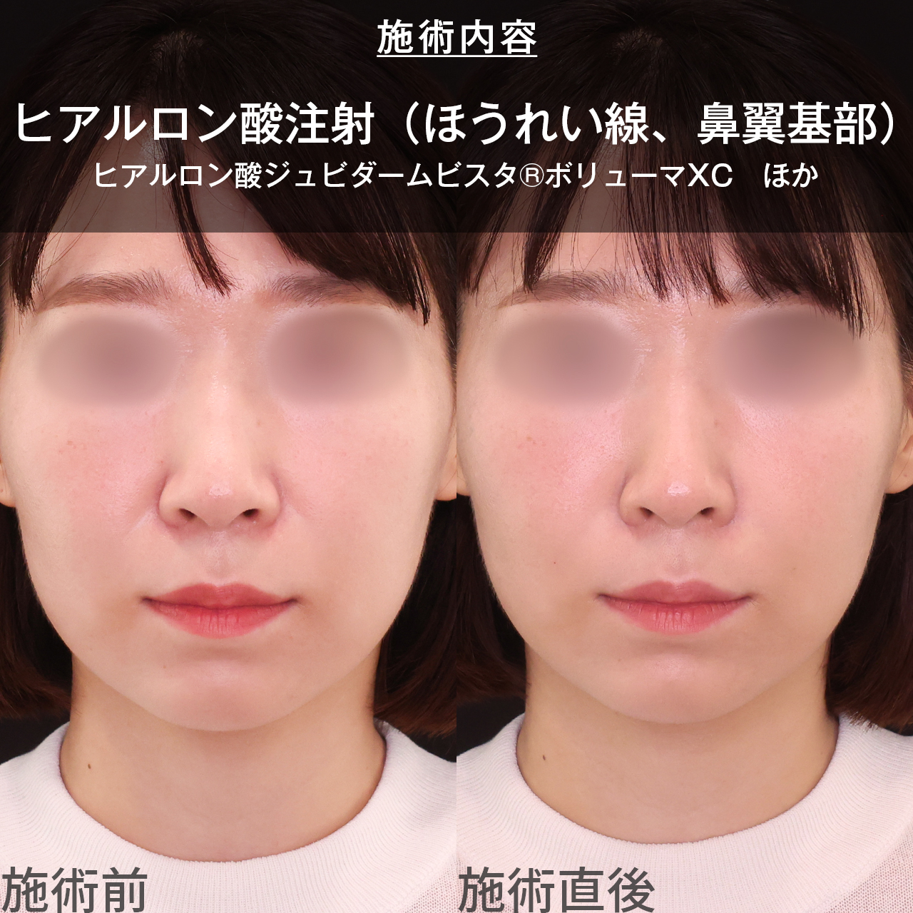 ほうれい線のヒアルロン酸注射/貴族手術（鼻翼基部プロテーゼ・脂肪注入・粉砕肋軟骨移植）の症例写真 施術前後 