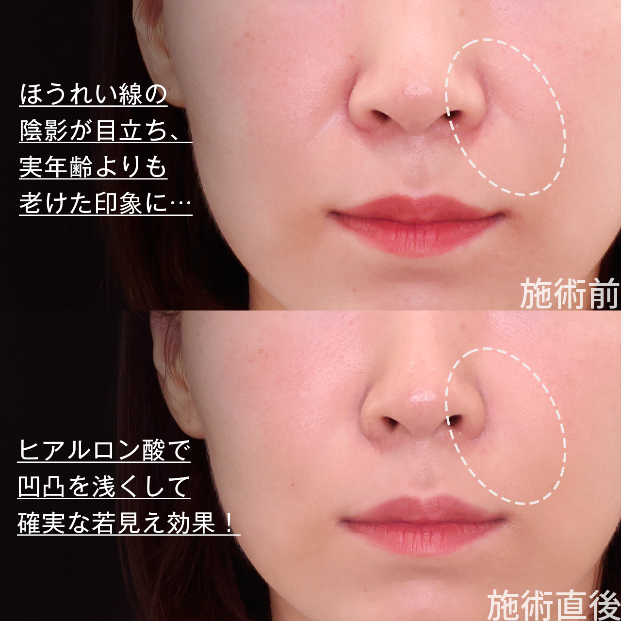 ほうれい線のヒアルロン酸注射/貴族手術（鼻翼基部プロテーゼ・脂肪注入・粉砕肋軟骨移植）の症例写真 施術前後 