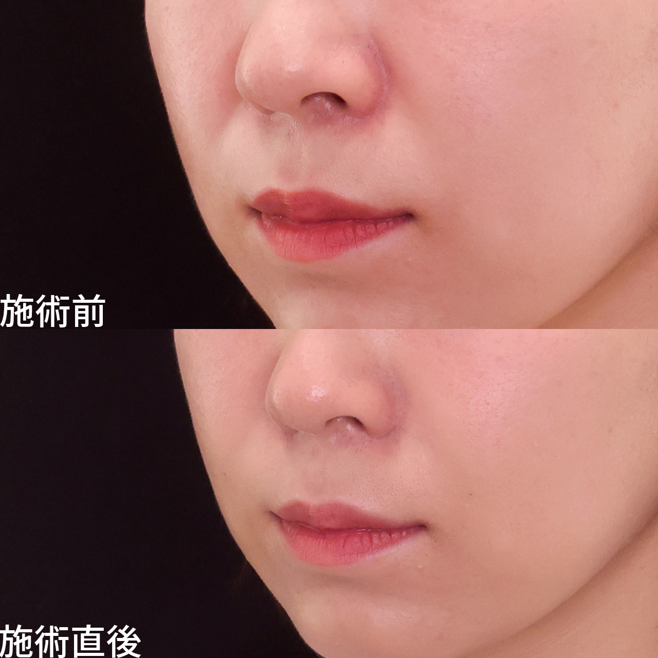 ほうれい線のヒアルロン酸注射/貴族手術（鼻翼基部プロテーゼ・脂肪注入・粉砕肋軟骨移植）の症例写真 施術前後 