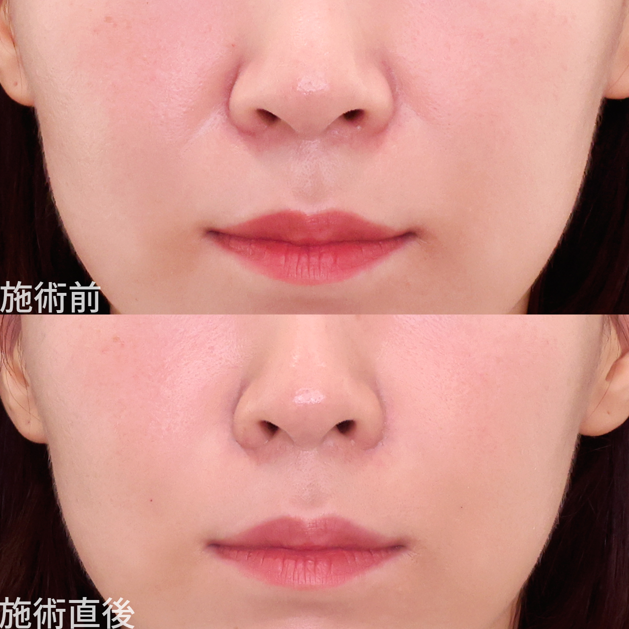 法令線と鼻翼基部の凹みを自然に浅くする