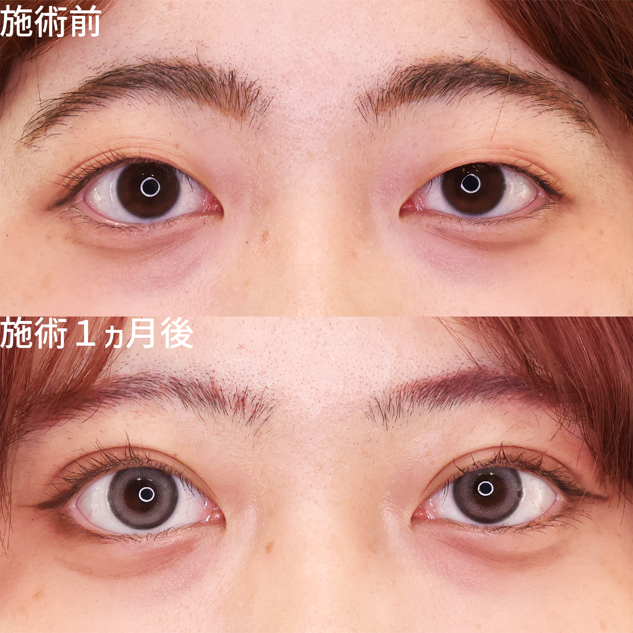 直後でも腫れ最小限！Dr.もりもりの二重施術